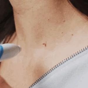 fast auto tag removal kit